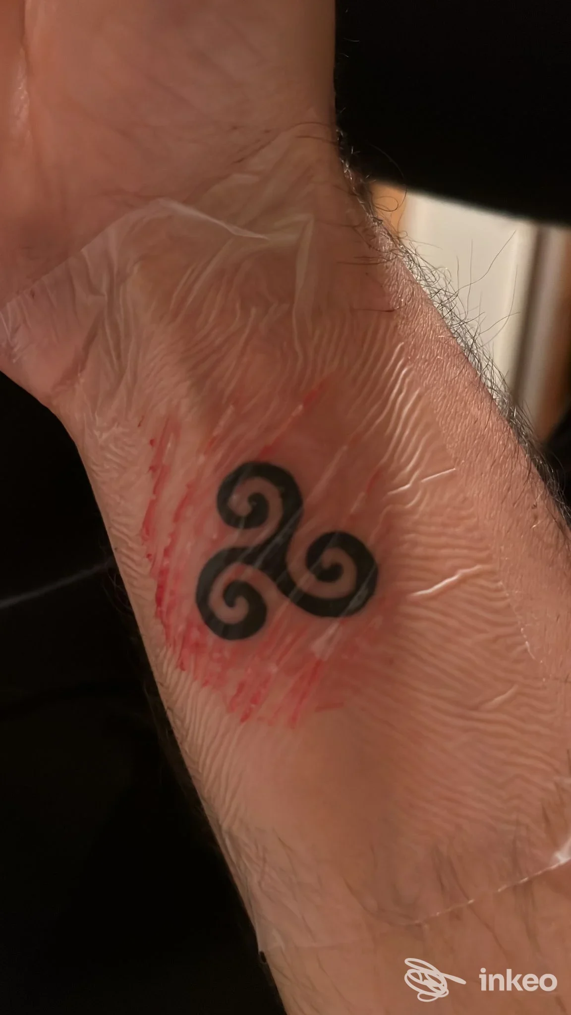 Avambraccio con tatuaggio nero a forma di tre spirali, bordi ben definiti e rossore intorno; nessun volto visibile.