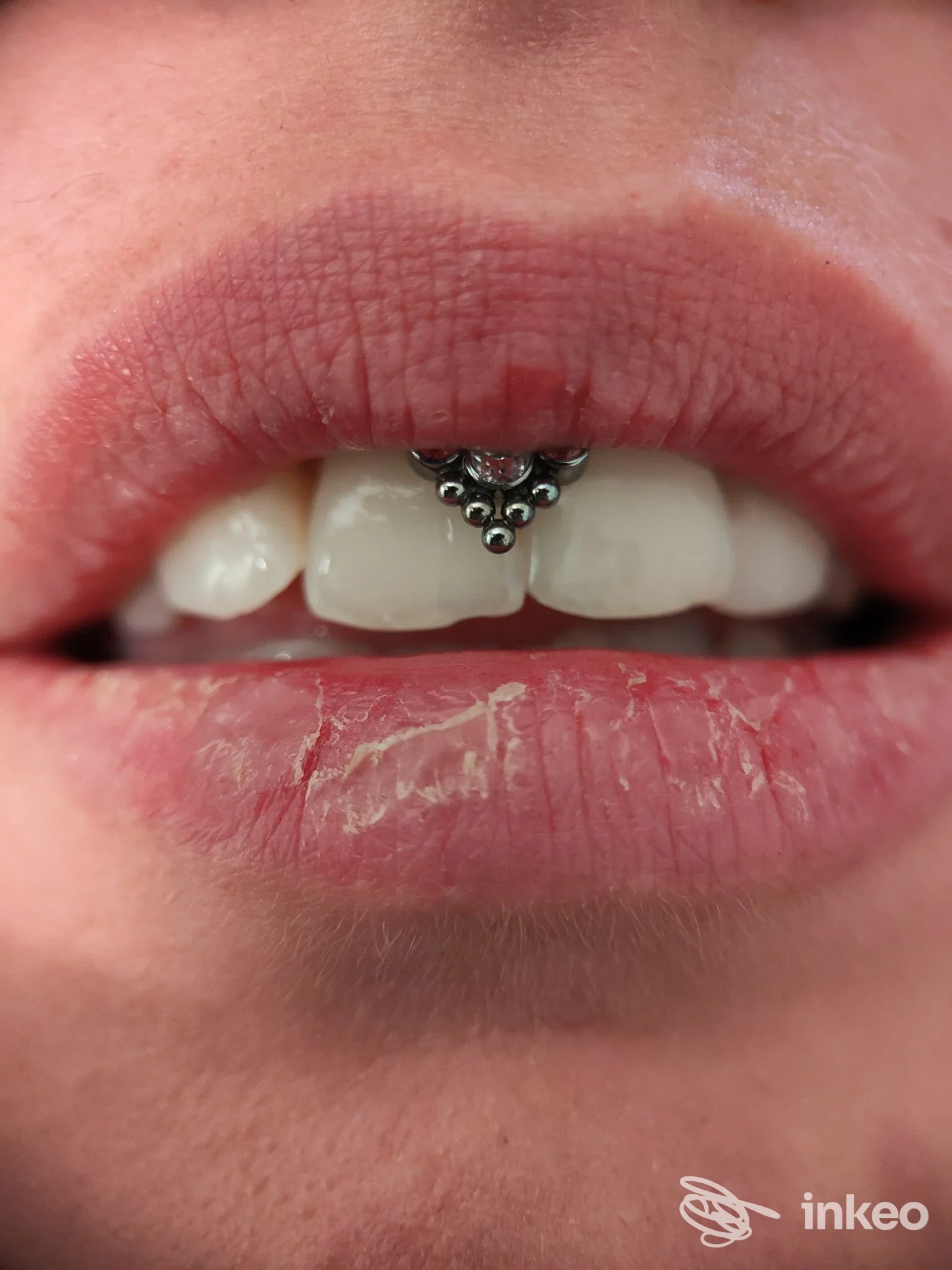 Primo piano delle labbra con piercing composto da piccole sfere metalliche tra i denti superiori. si vede la pelle delle labbra e una parte del mento.