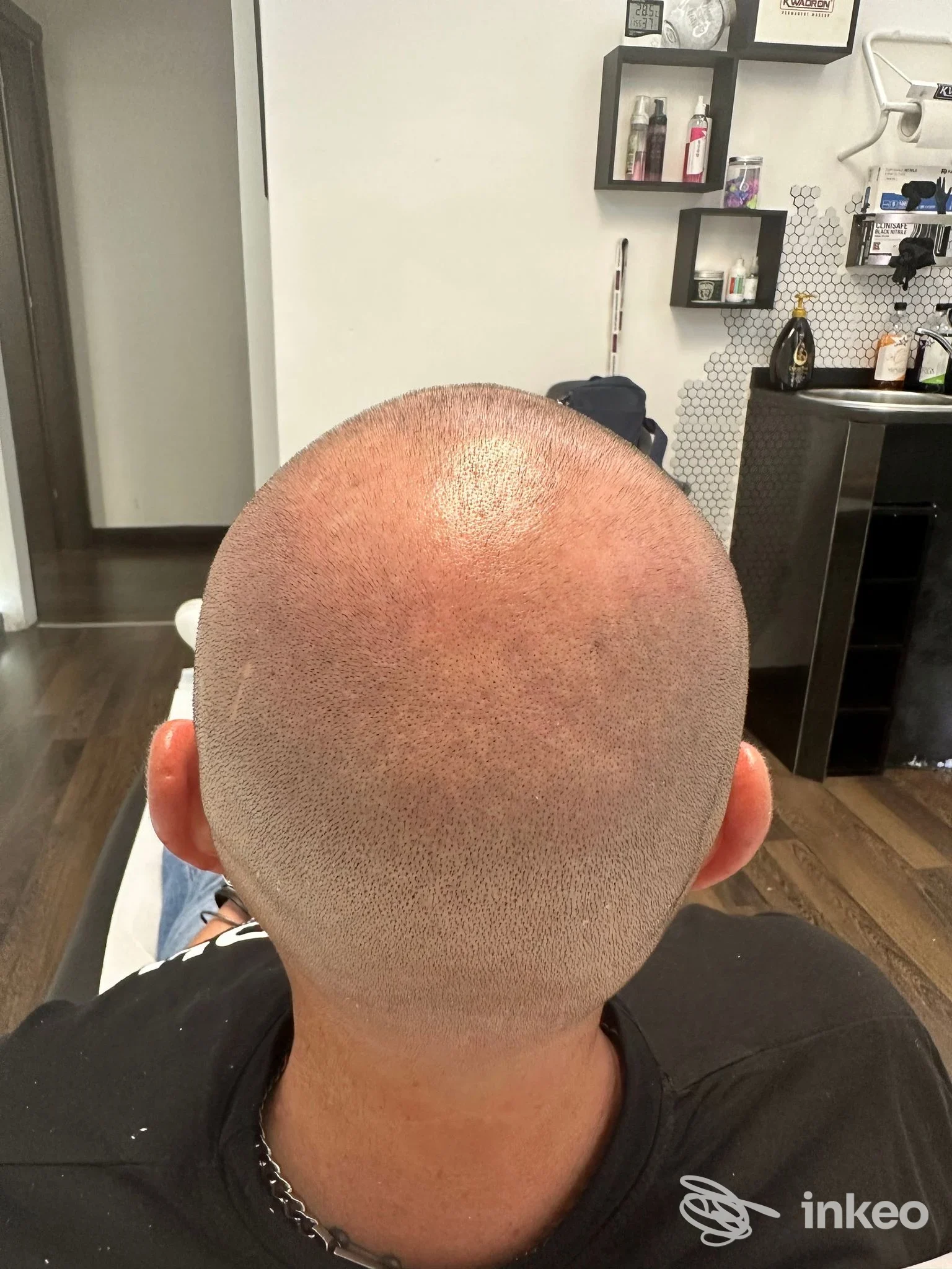 Testa rasata con pigmentazione del cuoio capelluto visibile sulla nuca, tipico effetto scalp micropigmentation.