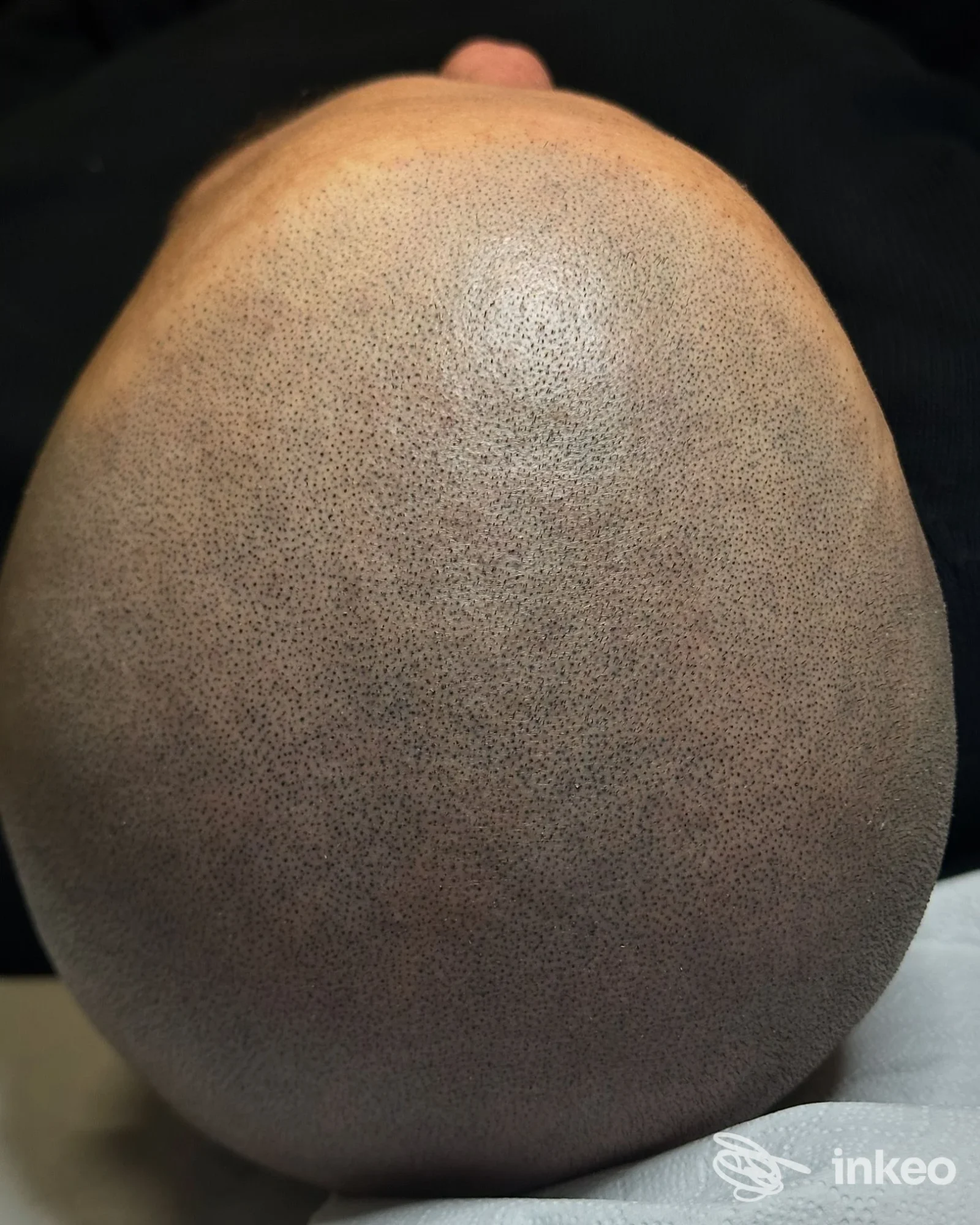 Scalp micropigmentation su testa rasata: micropunteggi pigmentati che simulano capelli sulla pelle.