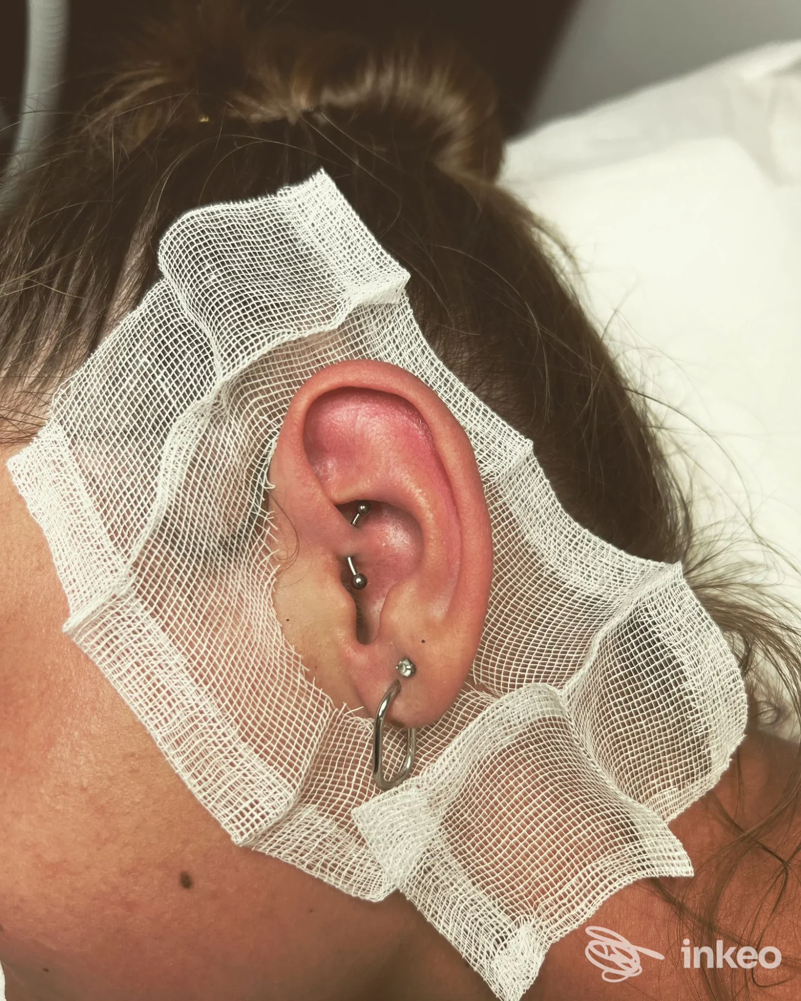 Orecchio di una persona con piercing multiplo, inclusi anelli e barre discendenti, con garza bianca intorno all’orecchio, senza visione del volto.