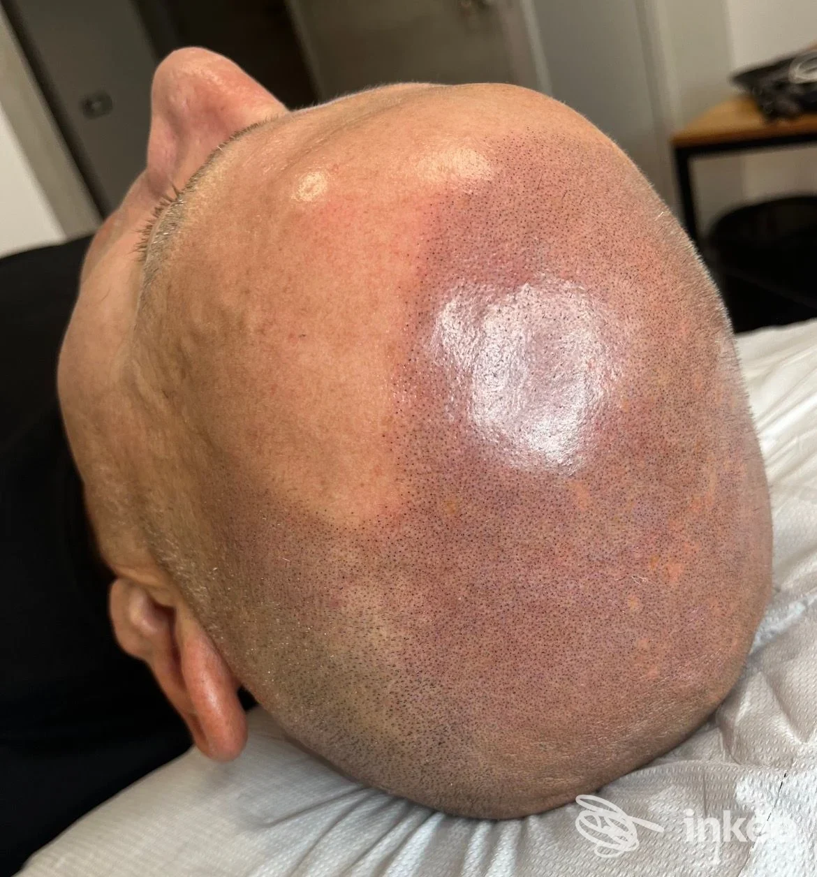 Tricopigmentazione su cuoio capelluto fotografata in primo piano allo Studio di Tricopigmentazione e Trucco Permanente di Francesca Bardi, Castelnuovo Magra.
