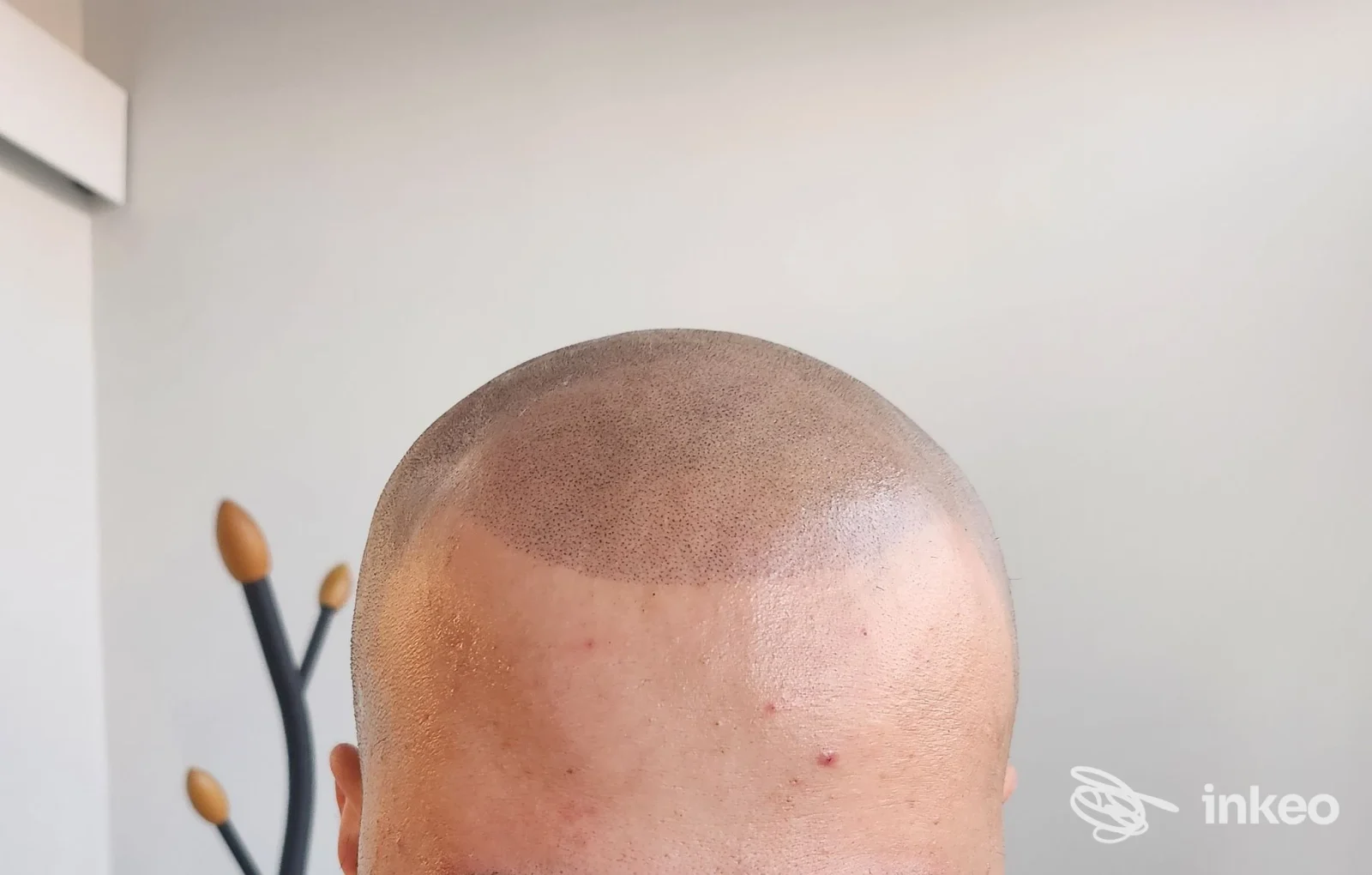 Tricopigmentazione visibile sulla sommità del capo, foto dello studio Trucco Permanente a Torino.