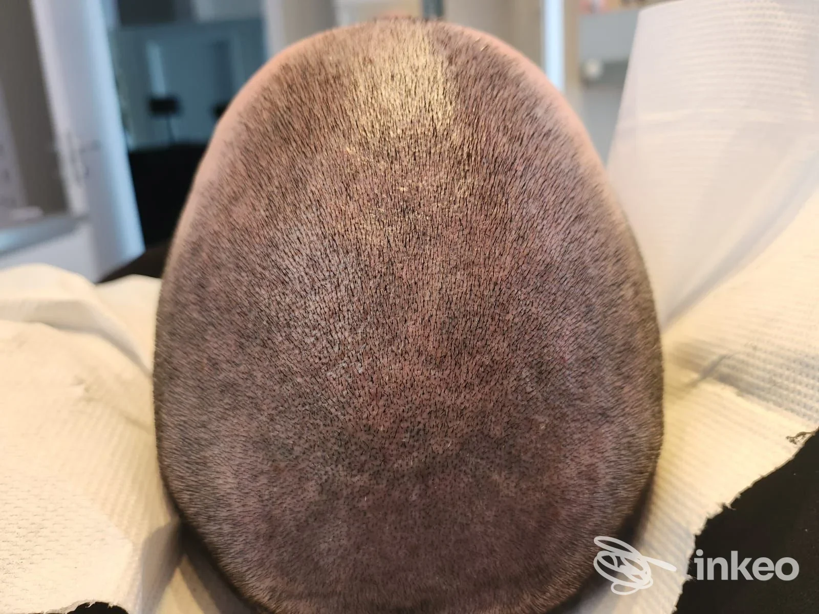 Tricopigmentazione sul cuoio capelluto eseguita da Trucco Permanente, Dermopigmentazione delle Areole, Tricopigmentazione Rosanna, Torino.