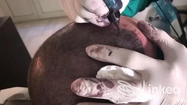 Operatore esegue dermopigmentazione sul cuoio capelluto di un cliente; primo piano dell'area trattata. Dermopigmentazione Puglia, Foggia.