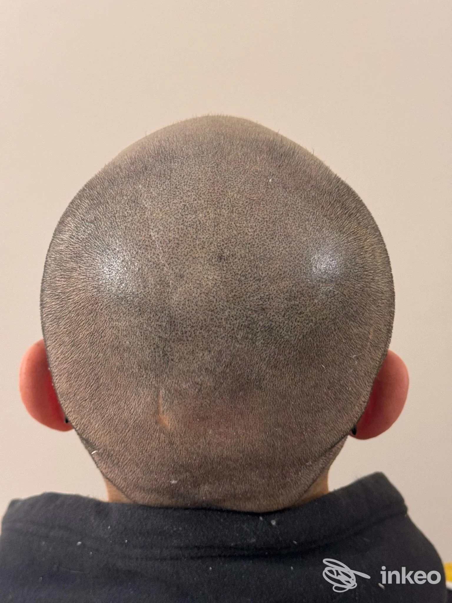 Tricopigmentazione sul cuoio capelluto vista da dietro, eseguita da Selene Fiorentini - Tricopigmentazione e trucco permanente, Carrara.