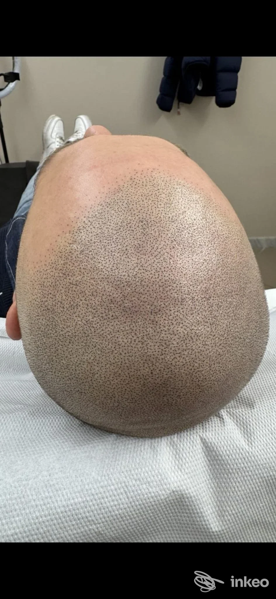 Tricopigmentazione sulla sommità del cranio eseguita da Selene Fiorentini, Carrara.