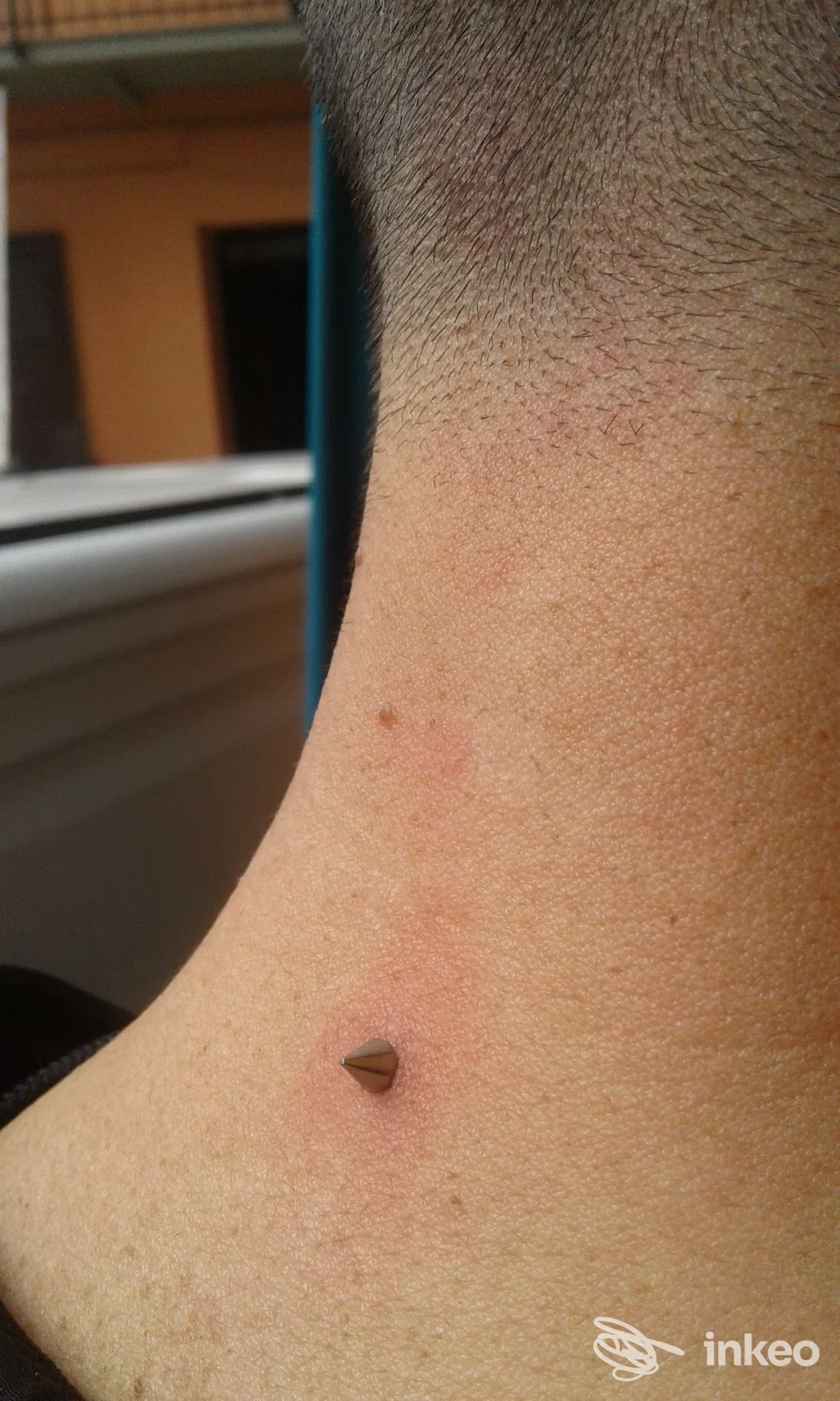 Piercing superficiale con gioiello a bottone sulla nuca di una persona, scatto ravvicinato. La Crisalide Piercing, Torino.