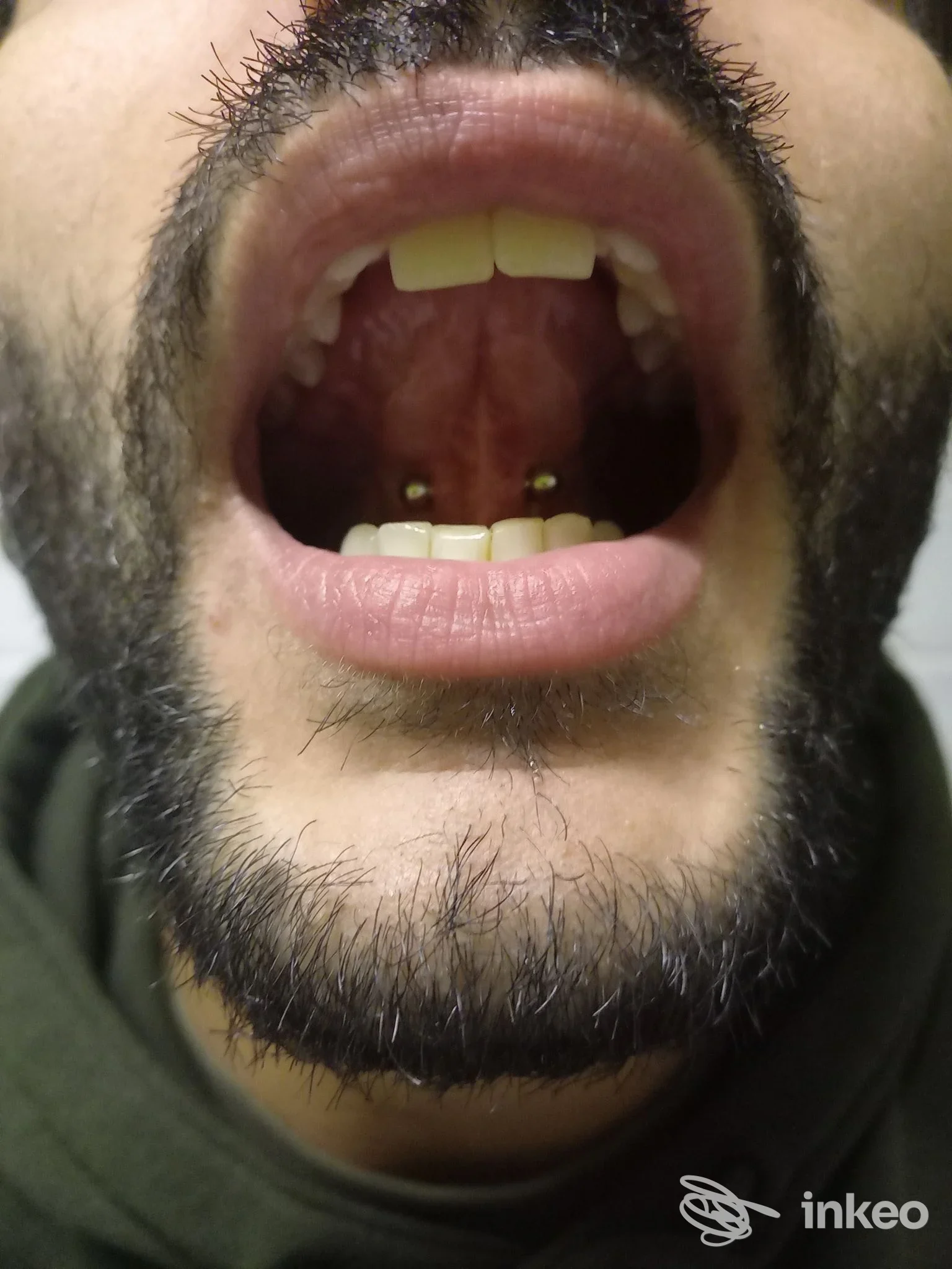 Primo piano della bocca aperta che mostra chiaramente un doppio piercing sublinguale con sfere metalliche visibili; immagine fornita da La Crisalide Piercing, Torino.