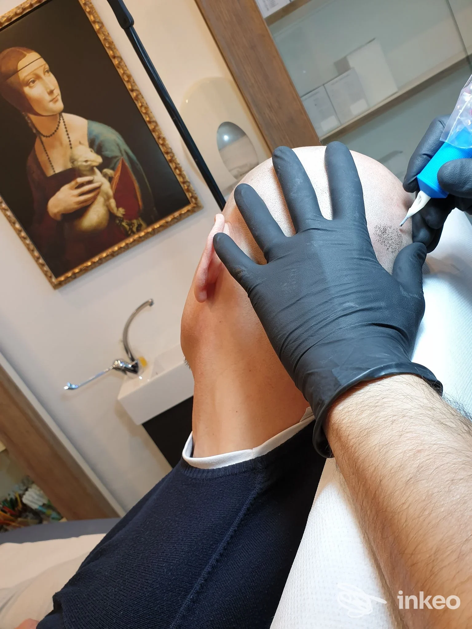 Operatore con guanti esegue tricopigmentazione sul cuoio capelluto in Centro Bucciardini Tricopigmentazione permanente, Firenze.