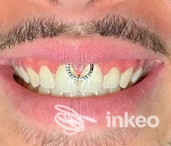 Primo piano di bocca con piercing gengivale mostrato dallo studio Tonibodymoodpiercer a Nettuno.