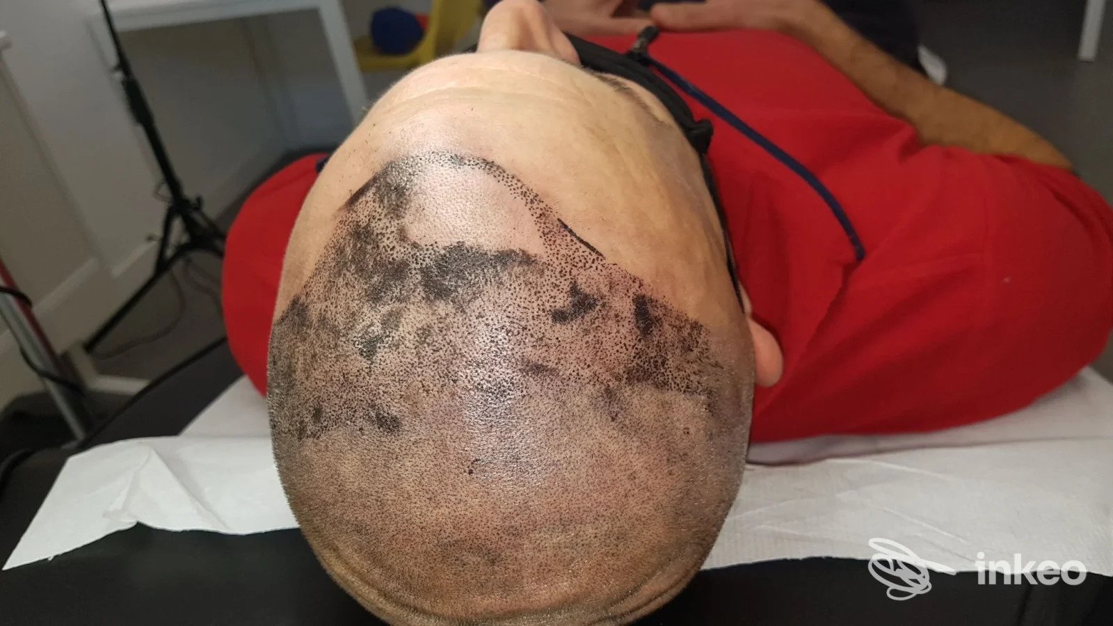 Micropigmentazione del cuoio capelluto su cliente sdraiato nello studio Sofia Ricci Trucco Permanente, San Benedetto del Tronto.