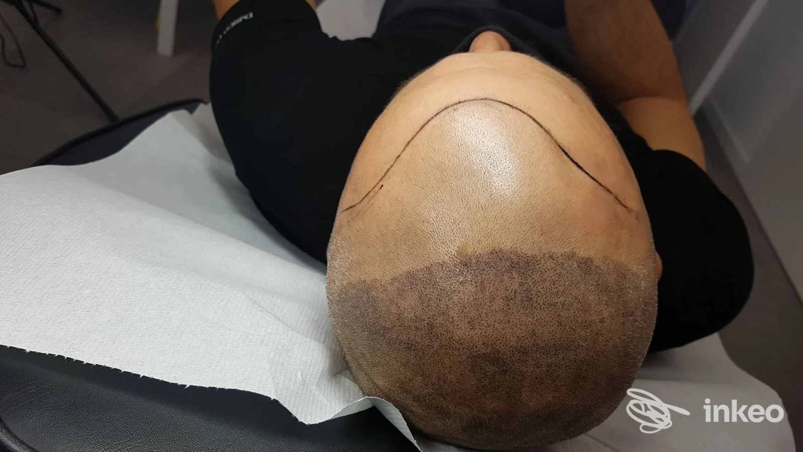 Micropigmentazione del cuoio capelluto in primo piano, lavoro mostrato sul capo presso Sofia Ricci Trucco Permanente a San Benedetto del Tronto.