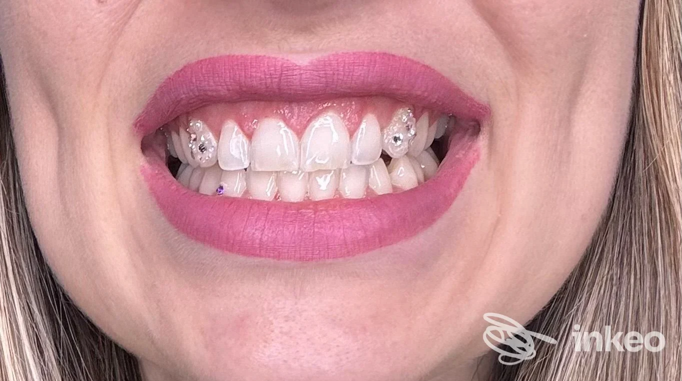 Primo piano del sorriso con gioielli dentali applicati, fotografia di Derma Room Nuoro, Nuoro.