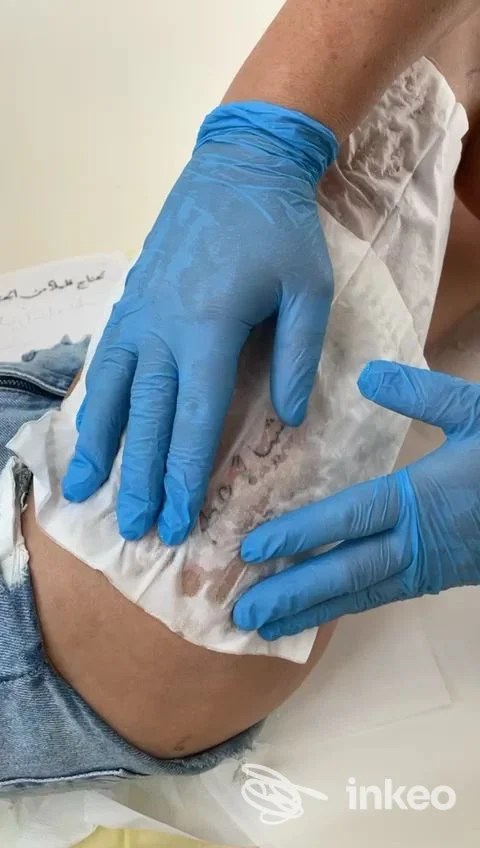 Tatuaggio sul fianco in fase di medicazione, mani con guanti blu. Estetica Tatuaggi Piercing TruccoSemipermanente Effetto Donna, Ortona.
