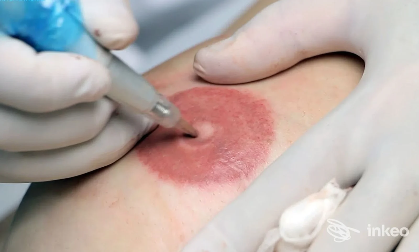 Dermopigmentazione dell'areola eseguita in studio Valis a Varese, primo piano della procedura su pelle reale.
