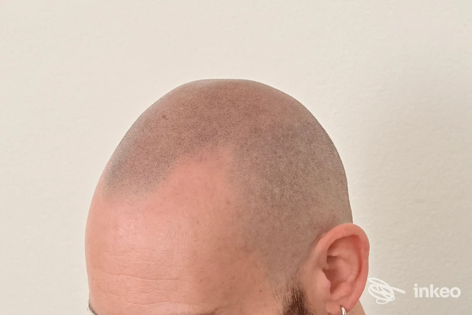 Tricopigmentazione sul cuoio capelluto in primo piano, lavoro eseguito da SM Tricoartist, Udine.
