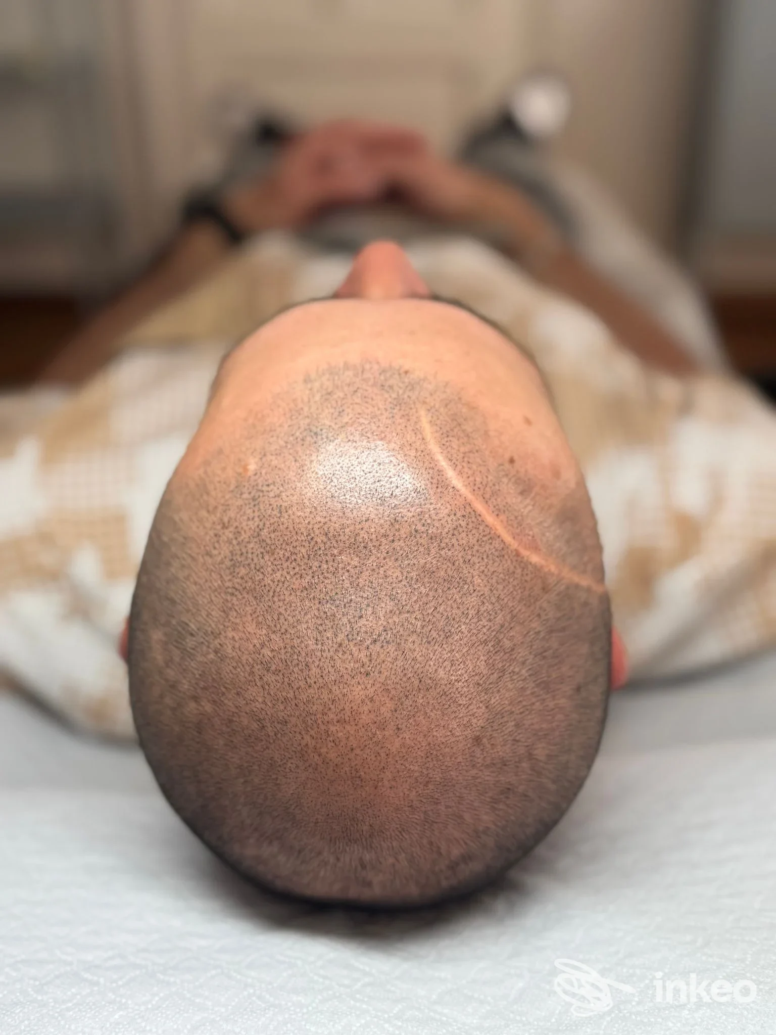 Tricopigmentazione sul cuoio capelluto con cicatrice visibile, foto di SM Tricoartist a Udine.