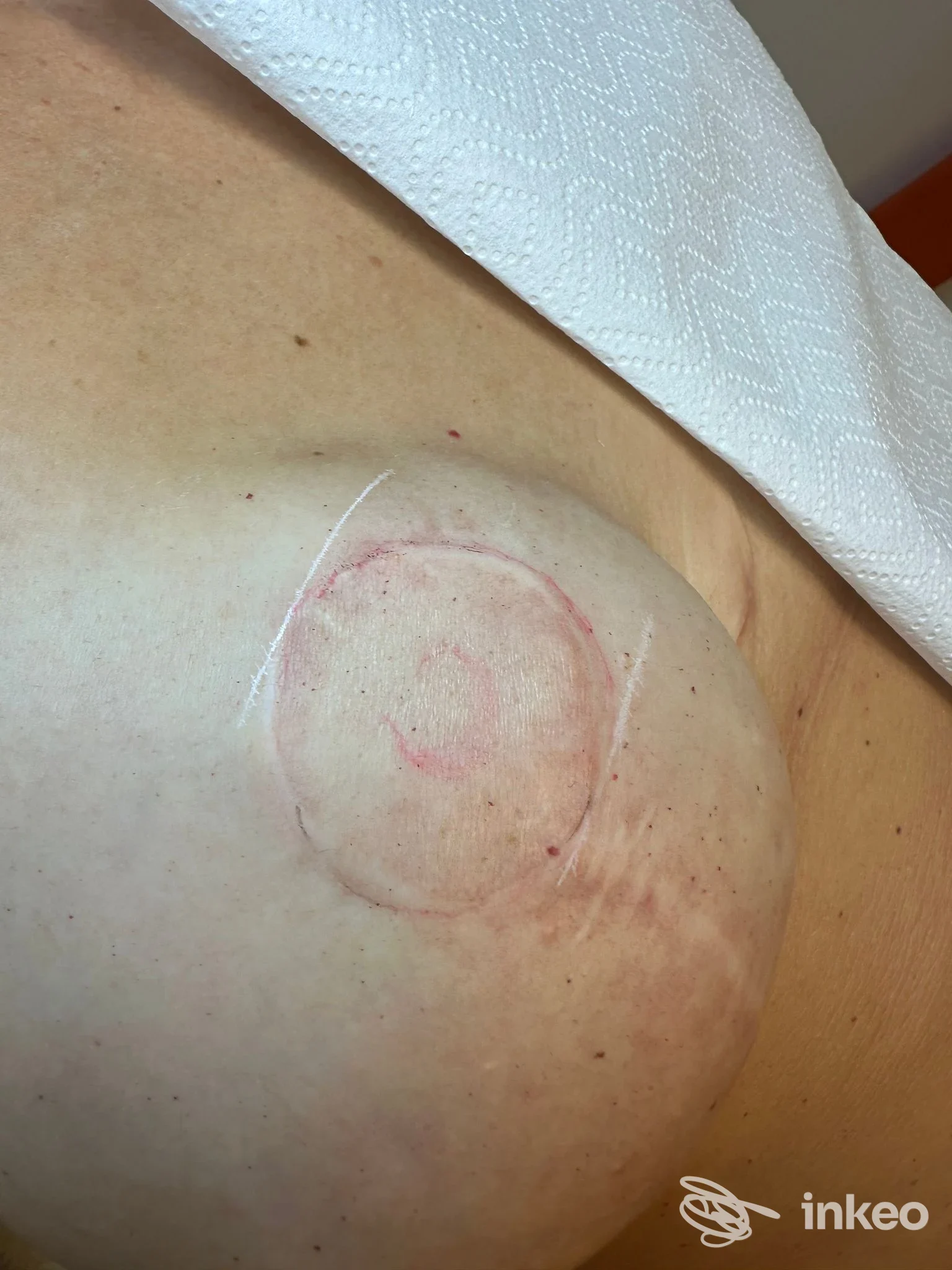 Dermopigmentazione medicale sull'areola del seno in fase di lavoro presso Anna Cappellari Trucco Permanente, Vicenza.