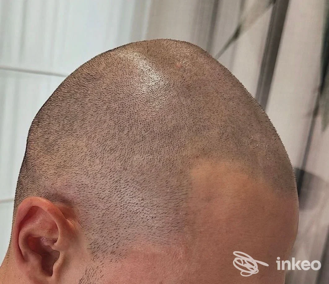 Dettaglio di tricopigmentazione sul cuoio capelluto, foto a cura di TRICOPIGMENTAZIONE & DERMO CAGLIARI - SECRET INK, Su Planu.
